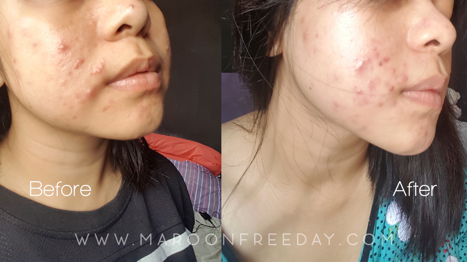Review H2 Pure Skin Suplemen Untuk Kulit Sehat Maroon Freeday