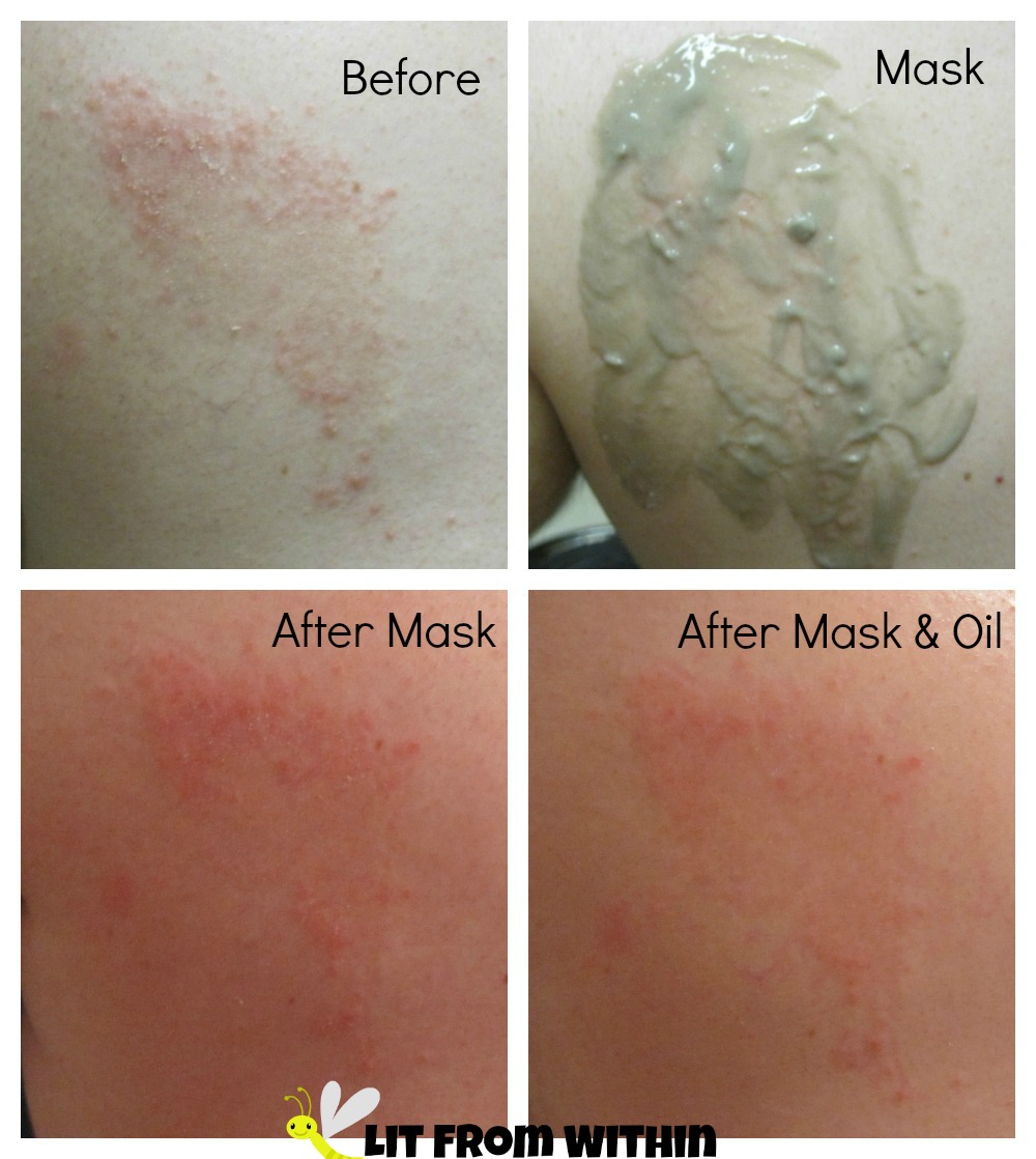 Hubby's eczema rash using Majestic Pure Indian Healing Clay