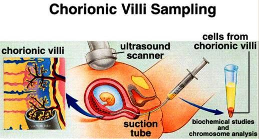my family medicine practice chorionic villus sampling chorionic villus sampling
