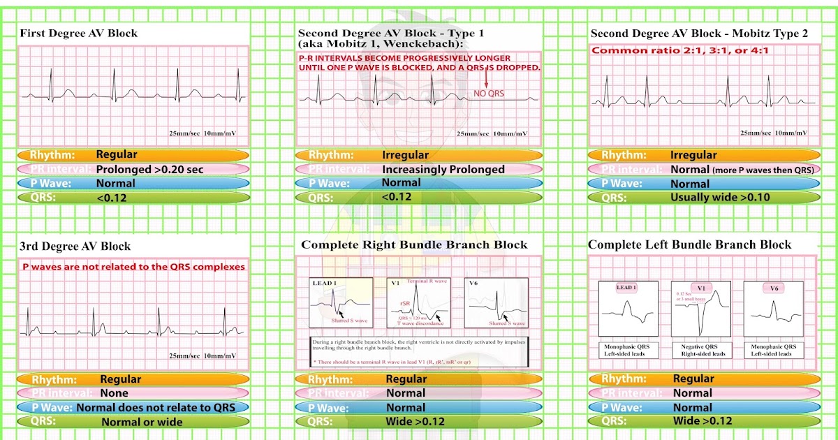 ECG Educator Blog Heart Blocks