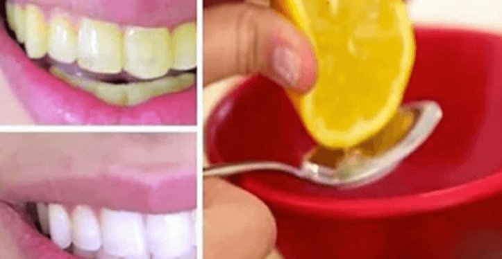 Watch Your Teeth Whitening With This Home Remedy!