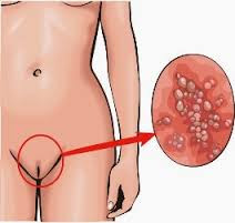 Image Obat Oles Kutil Kelamin Tokcer