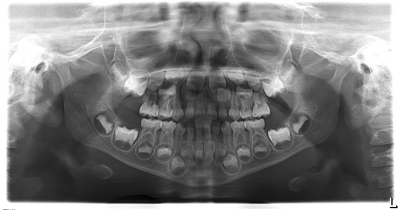 Salud dental, salud global.: La dentición en los niños