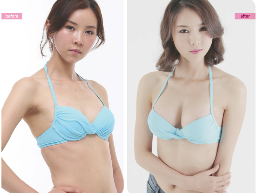 Synergy Plastic Surgery: FAQ on Breast Surgery Natural B Cup Breast.