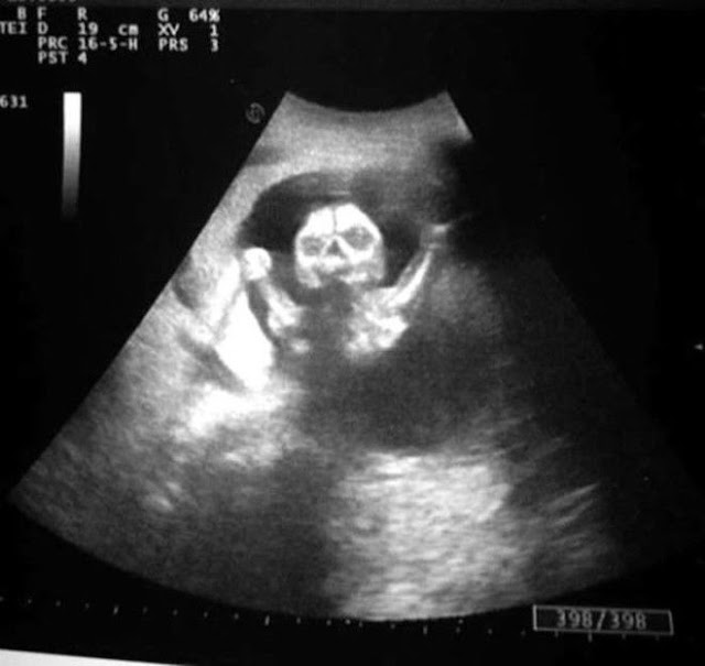 foto usg bayi paling mengerikan dan juga menyeramkan yang membuat bulu kuduk berdiri-7