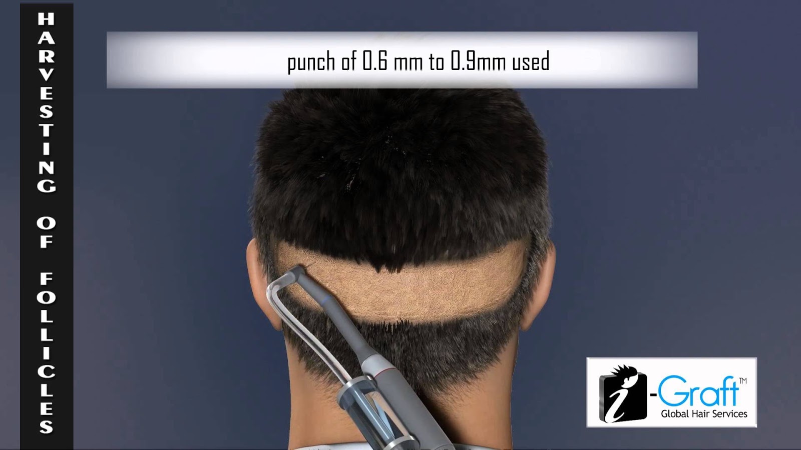 What is Direct Follicle Implant Hair Transplant