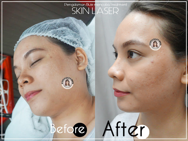 Setelah+perawatan+di+JPP+Skin+Laser+Clinic 