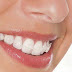 Ưu thế của các loại niềng răng tự buộc bạn nên biết