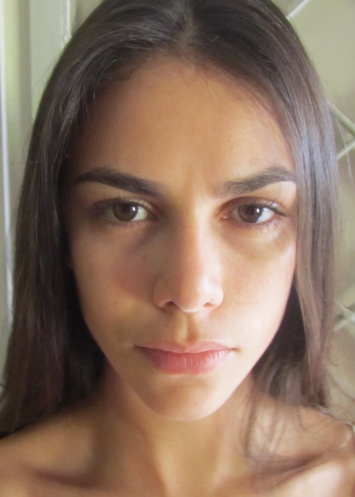 Rinoplastia Antes e Depois