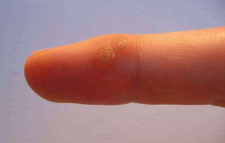 Se è possibile spalmare la psoriasi con perossido di idrogeno