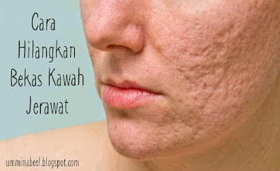 Hilangkan bekas kawah jerawat dengan Youth Skincare Shaklee