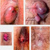 Obat Tradisional Ambeien Eksternal thumbnail