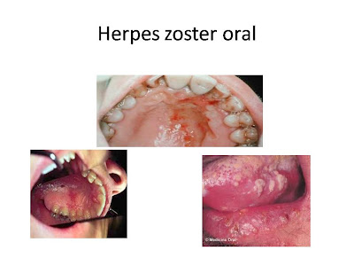 Herpes zoster oral