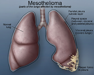 Mesothelioma - Catch It Early to Avoid Big Trouble Mesothelioma - Catch It Early to Avoid Big Trouble