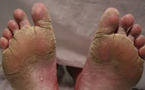 obat eksim kering pada kaki dan tangan di apotik