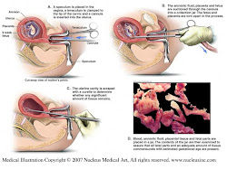 Abortion of 9 week fetus