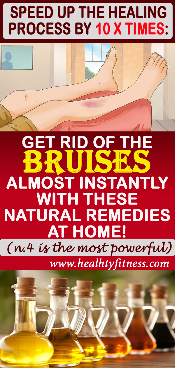 How To Get Rid Of Bruises Naturally Nutrition Health
