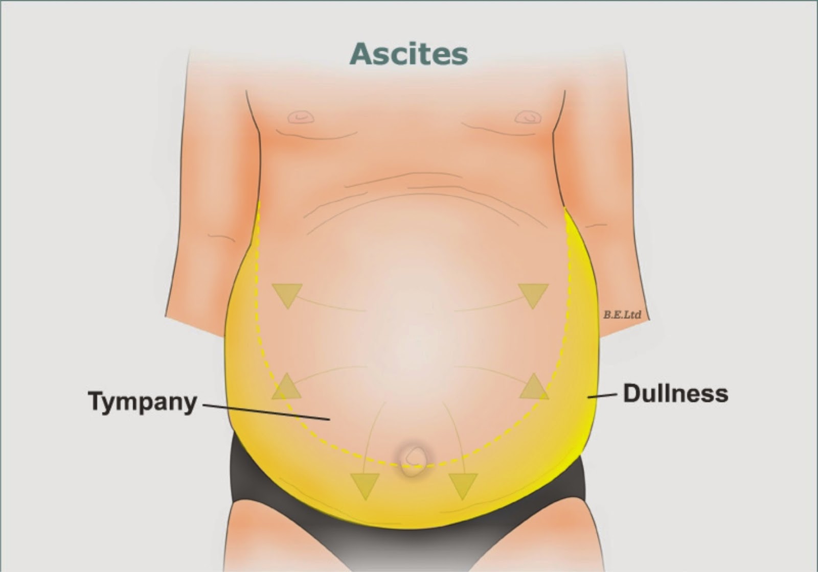 Асцит причины симптомы. Цирроз печени голова медузы асцит. Скопление жидкости в брюшной полости. Скопилась жидкость в брюшной полости. Скопление жидкости в юрюшной полост.