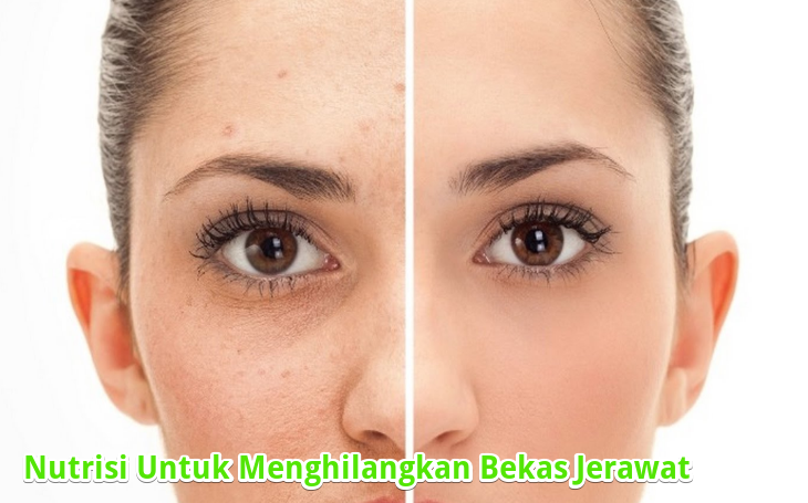 Cara Menghilangkan Bekas Jerawat Dengan Sangat Mudah Cara Menghilangkan Bekas Jerawat Dengan Sangat Mudah