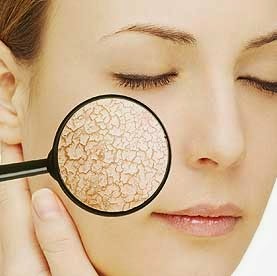 Cara Mengatasi Kulit Wajah yang Kering dan Kusam Cara Mengatasi Kulit Wajah yang Kering dan Kusam