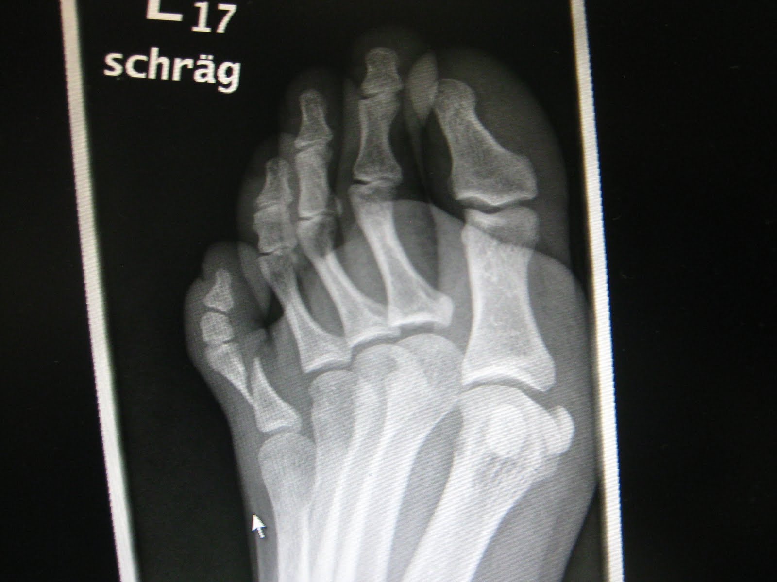 Swiss Miss: Broken Toe and Shattered Dreams