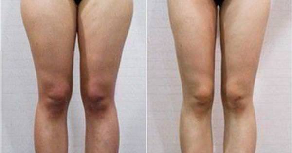 肌肉腿有救了！她做了一個月...蘿蔔腿不見了！腿又細又直...姐妹們都羨慕死了！