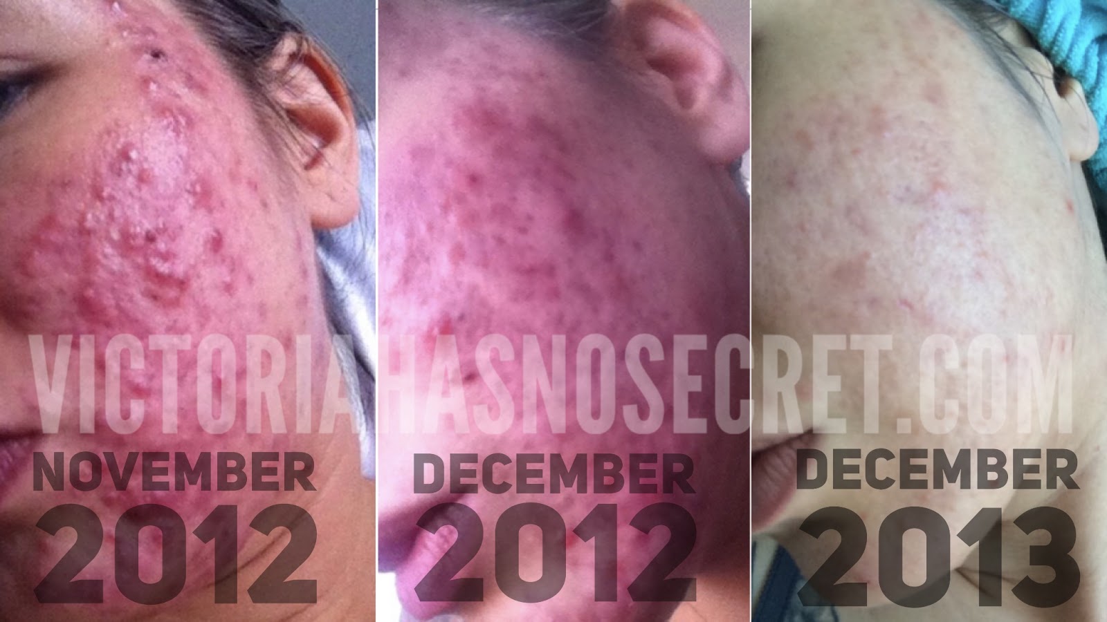 VICTORIAHASNOSECRET My Acne Story
