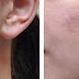 3 The most Famous Methods of Acne Scar Removal