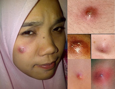 Cara Menghilangkan Bisul di Wajah Secara Alami Sampai Tuntas | Penjual