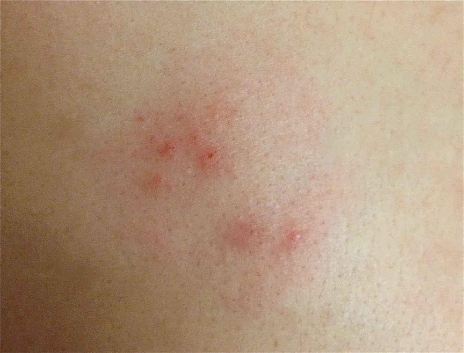 Identifying Bug Bites: 10 Common Types, Pictures, Symptoms