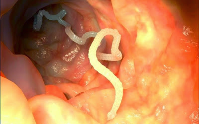 Signs You Have Worms In The Intestine Or Stomach - Remedy Herbs