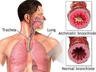 Obat Paru Paru Kering Tradisional Detopar Dan Pipeca Dari De Nature Obat%2BAsma%2BPaling%2BAmpuh%2BDe%2BNature%2BDetopar%2BPipeca