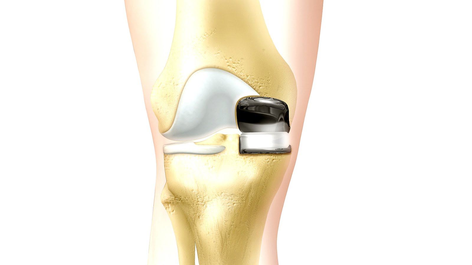 Эндопротезирование коленного сустава клиника. Протез коленного сустава Zimmer NEXGEN complete Knee solution. Эндопротезирование коленного сустава Zimmer NEXGEN. Искусственный коленный сустав.