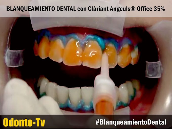 BLANQUEAMIENTO DENTAL con Clàriant Angeuls® Office 35%