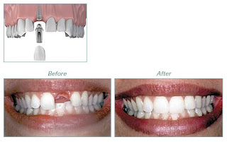 best teeth implants in Hertfordshire