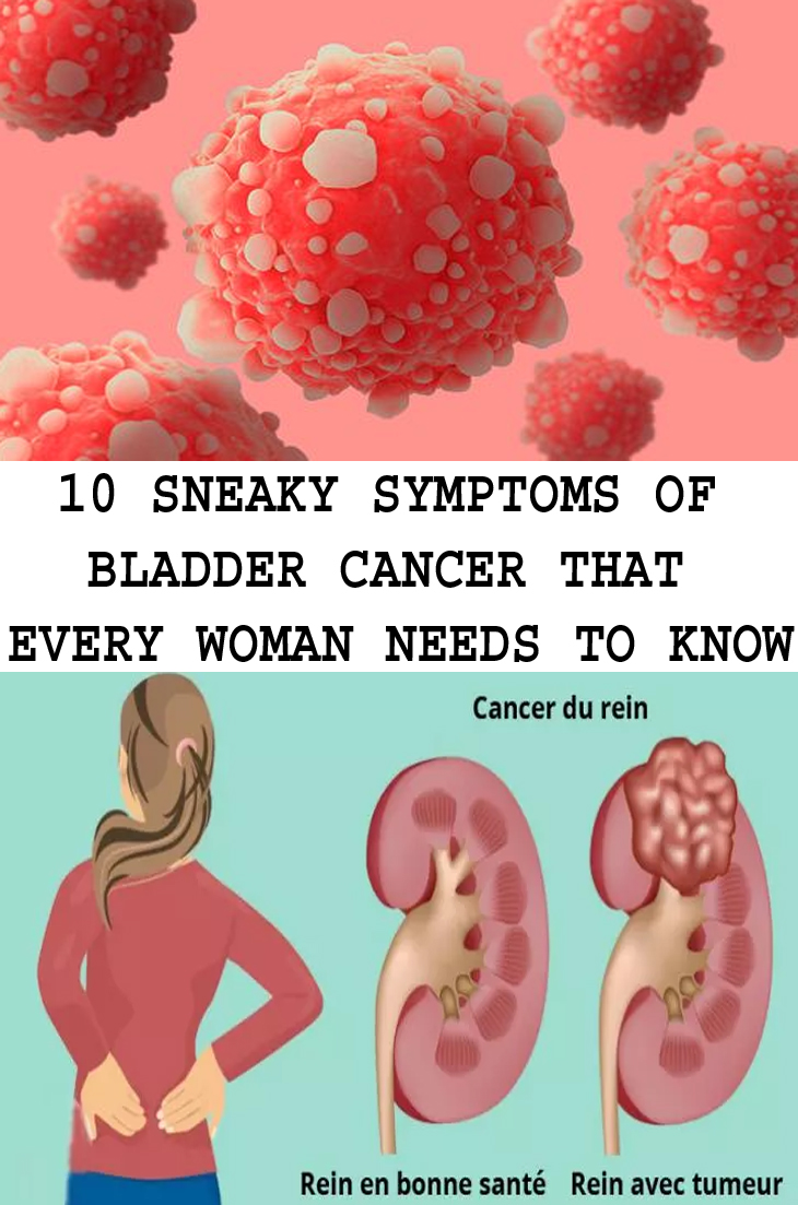 10 SNEAKY SYMPTOMS OF BLADDER CANCER THAT EVERY WOMAN NEEDS TO KNOW