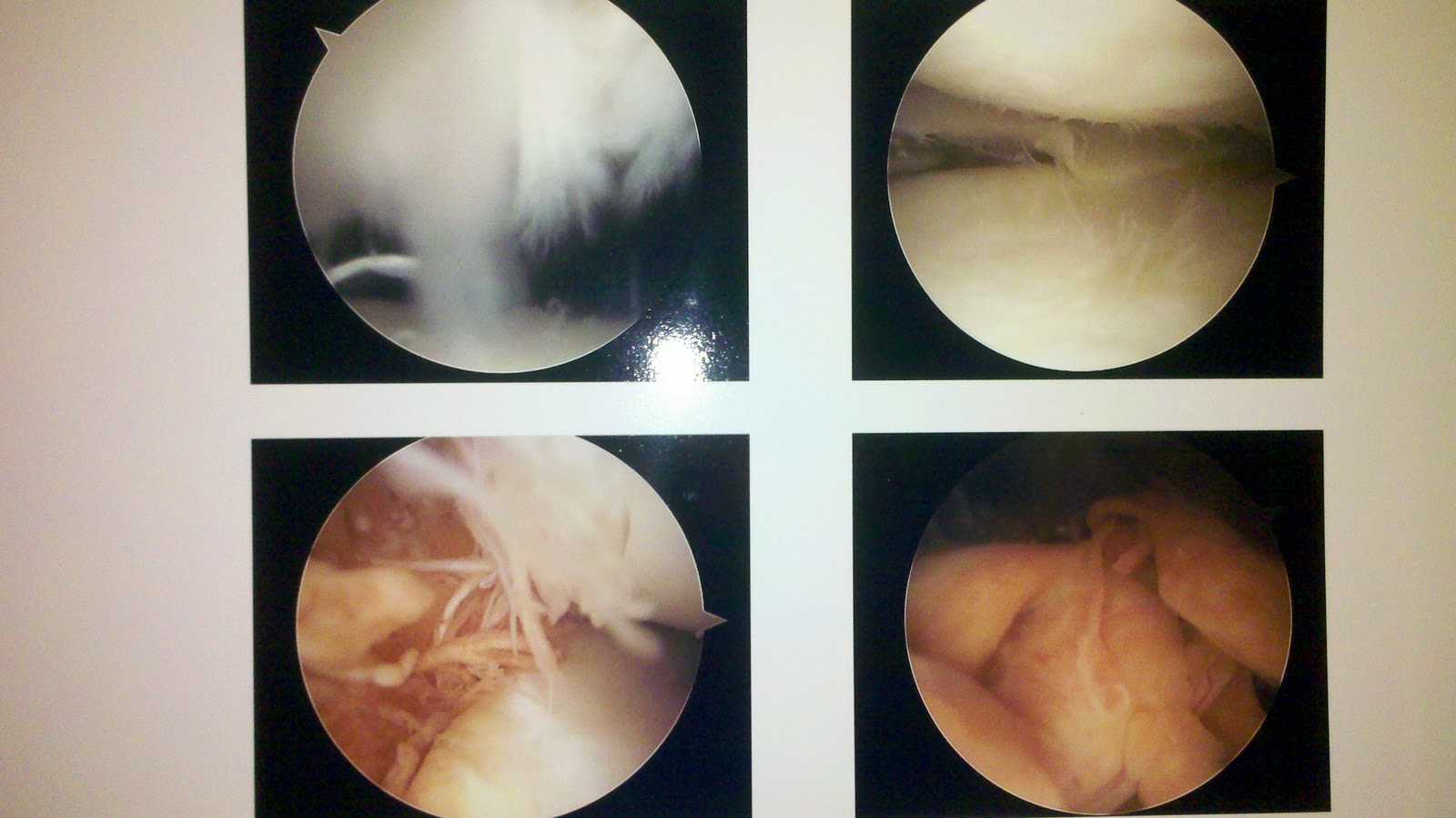 PVNS Success 3 Weeks PostOp Begin Physical Therapy