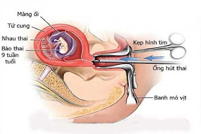 Hút phá thai 1 tháng tuổi an toàn