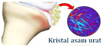 Obat Asam Urat ! Ketahui Obat,Penyebab Dan Pantangan Asam ...