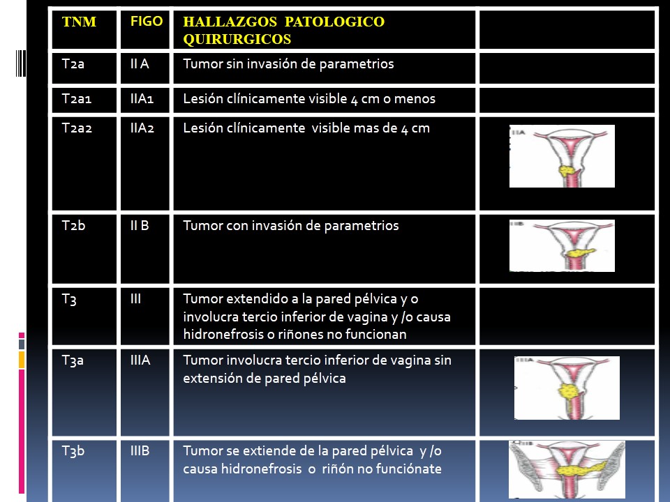 Cancer de Cuello Uterino