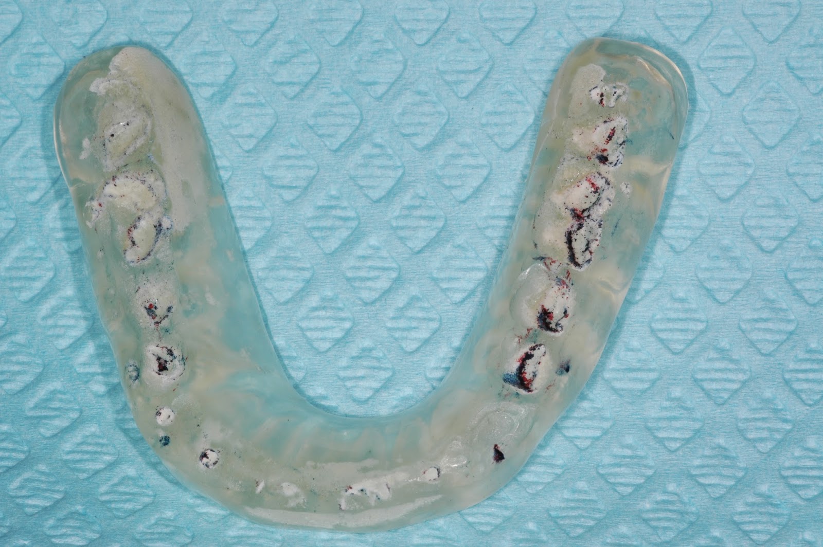 Occlusal Mouth Guard 116