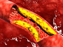 Apa yang terbayang pada benak kita ketika mendengar kata kolesterol?