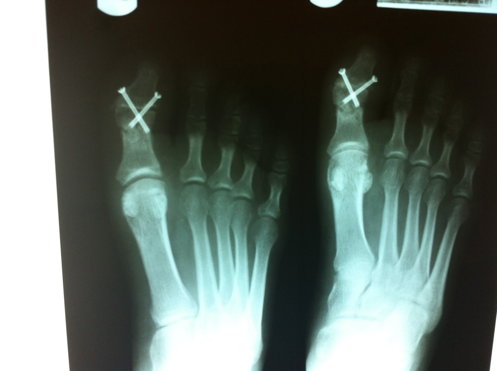 Foot and Ankle Problems By Dr. Richard Blake Big Toe Joint Fusion