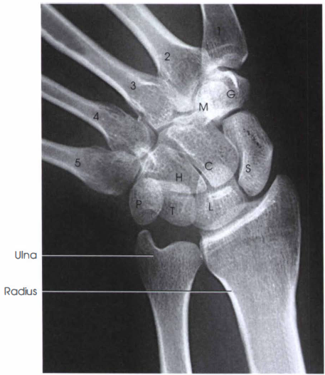Scaphoid x ray ulnar deviation radtechonduty