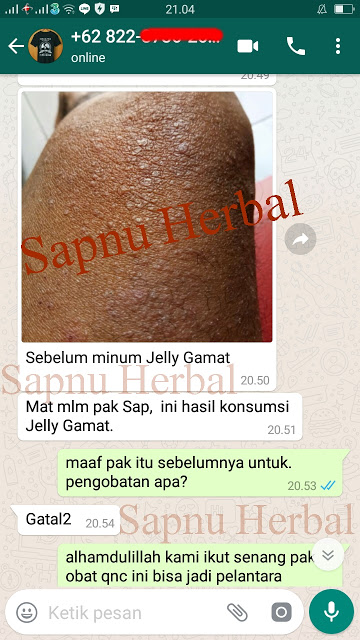 Cara Menghilangkan Bintik Merah Seperti Jerawat Di Kulit Perut Terbukti Mujarab ~ TESTIMONI QNC JELLY GAMAT Cara Menghilangkan Bintik Merah Seperti Jerawat Di Kulit Perut Terbukti Mujarab ~ TESTIMONI QNC JELLY GAMAT