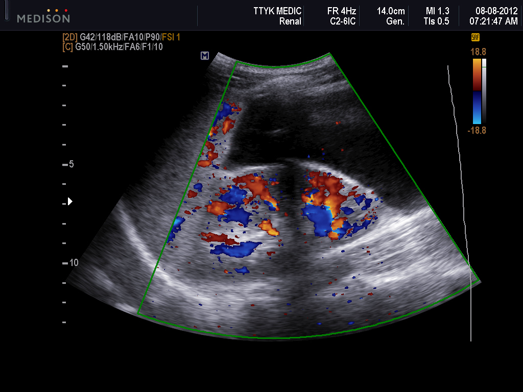 VIETNAMESE MEDIC ULTRASOUND CASE 135 HUGE CYSTIC
