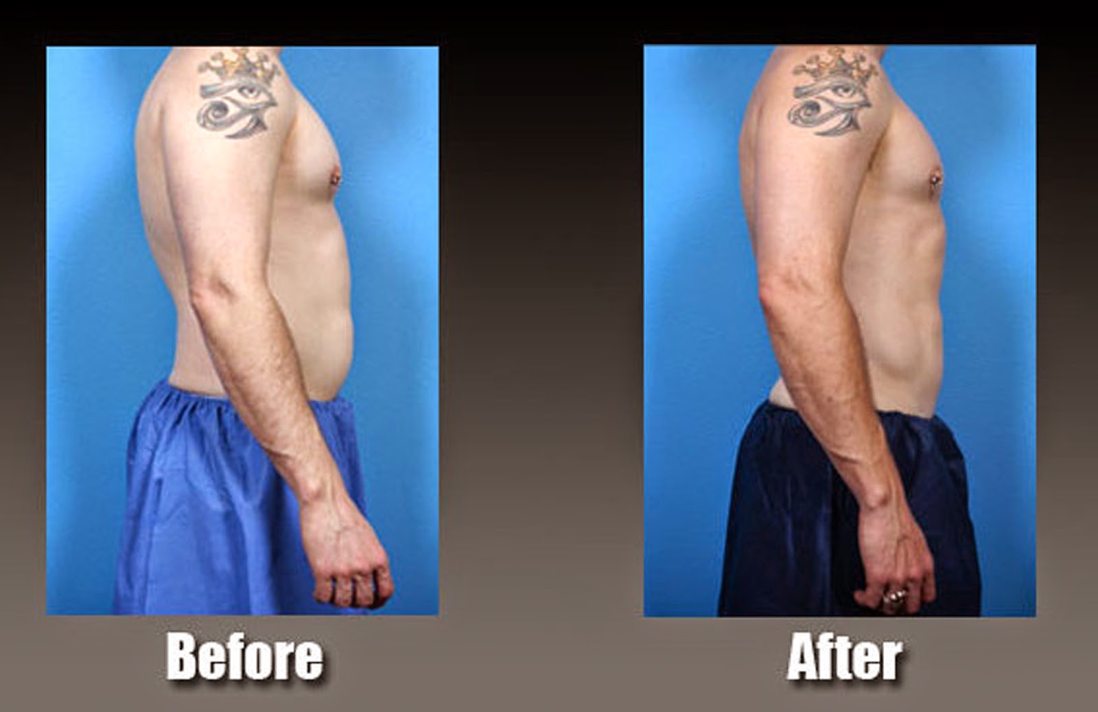 Liposuction Las Vegas