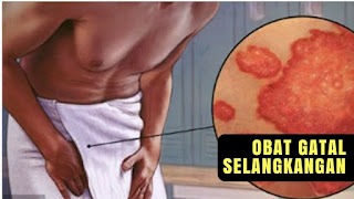 Obat Gatal Selangkangan Obat Gatal Selangkangan