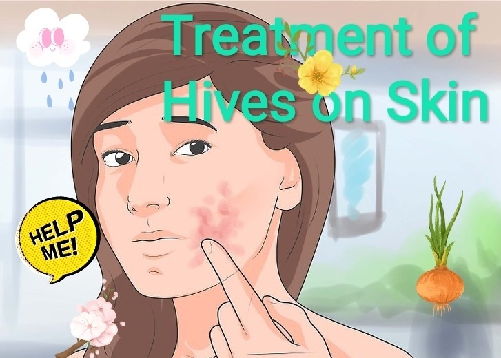 Hives On Face Treatment Doctor Heck