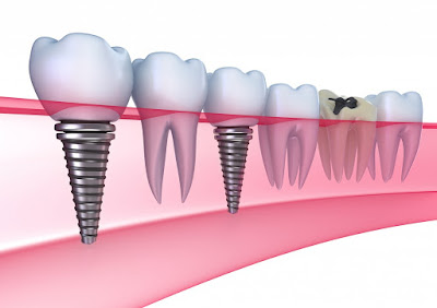 Thực hiện cấy ghép răng Implant có đau hay không?